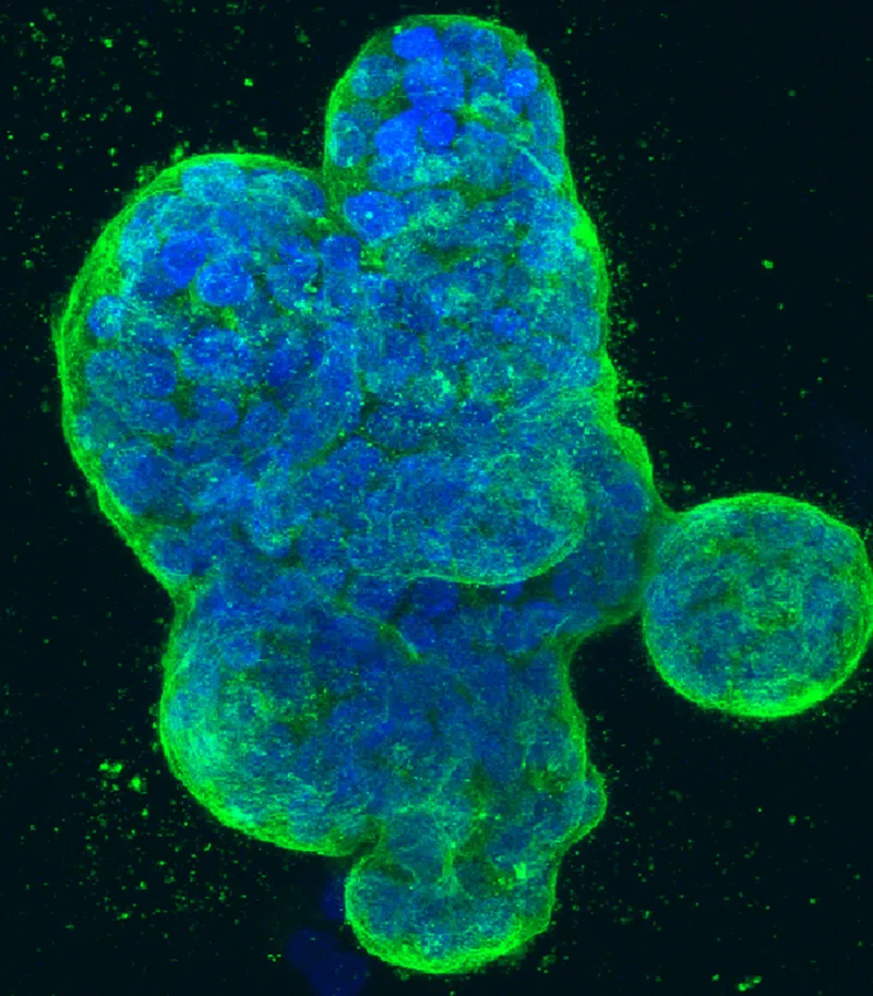 Australian Scientists Find Key Driver of Aggressive Breast Cancer