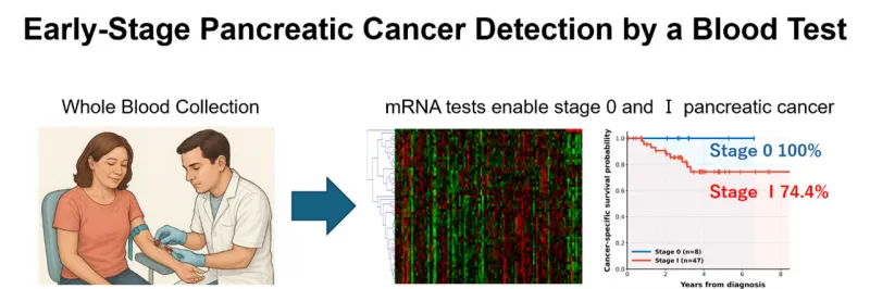 Blood test detects 90% of early pancreatic cancers
