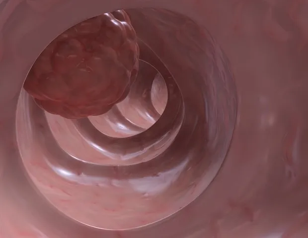 La suppression d'un gène rend les cellules du cancer du côlon vulnérables à l'immunothérapie