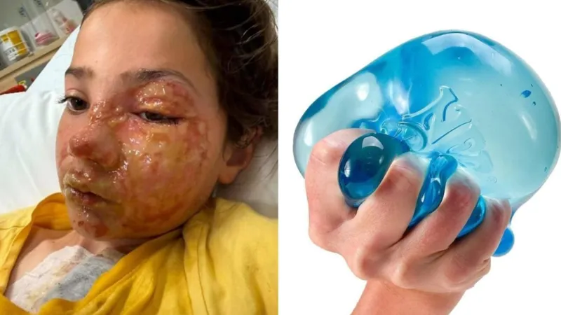 Girl Burned by Microwaved Fidget Toy, Dad Faces Online Abuse
