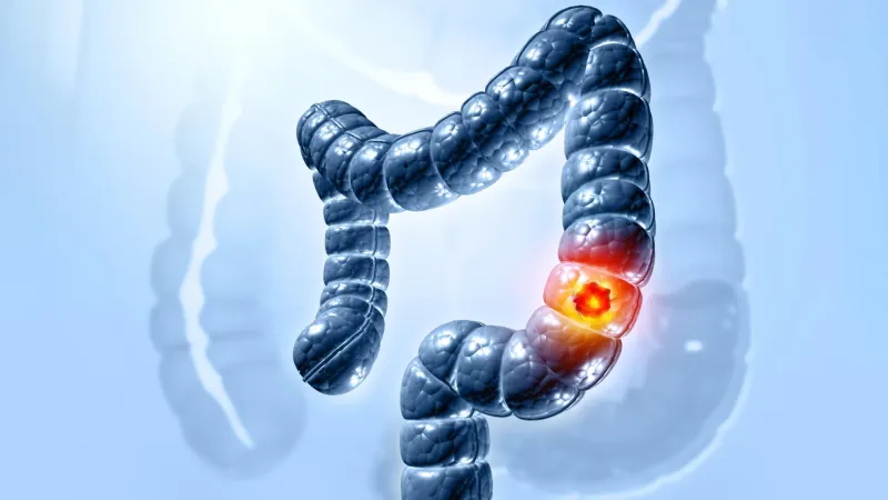 Gut Bacterium's Role in Colon Cancer Uncovered