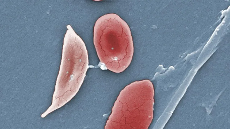 India Revises Anaemia Mukt Bharat Guidelines