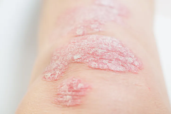 Ixekizumab and Tirzepatide Combo for Psoriasis and Obesity