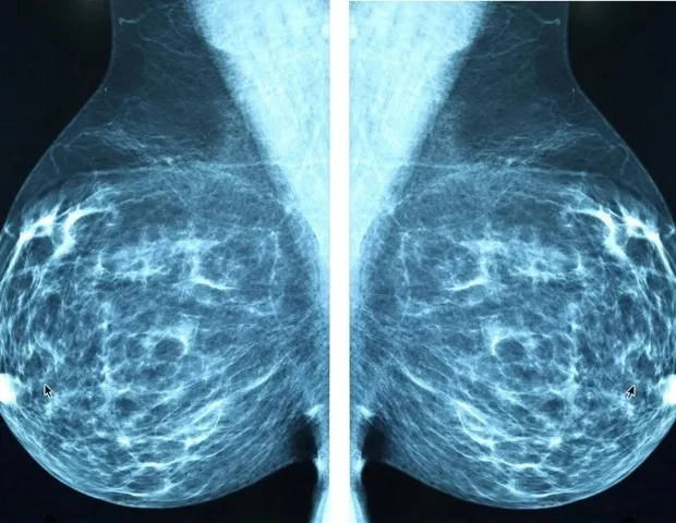 Low-dose endoxifen reduces breast density without side effects