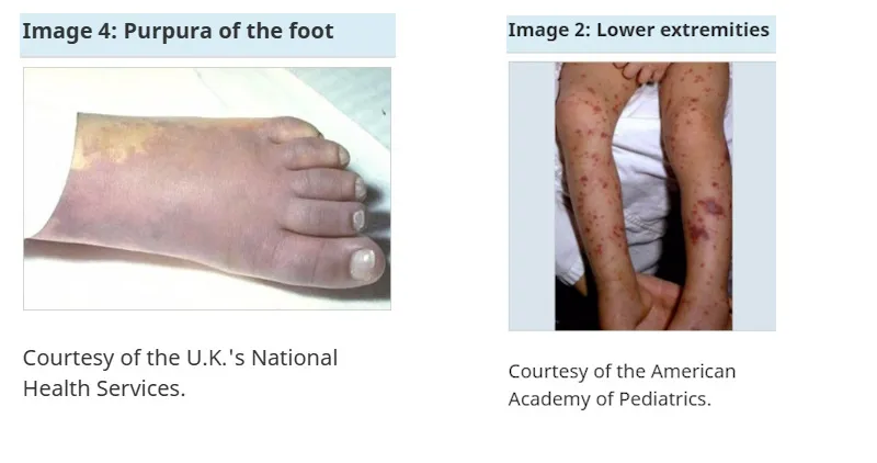 Meningococcal Outbreak in Central Newfoundland