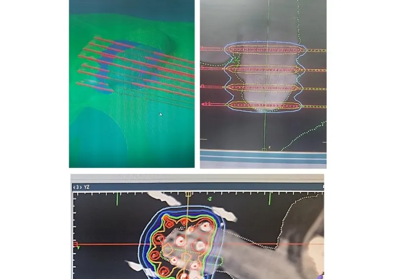 Moroccan 3D-Printed Brachytherapy for Penile Cancer Published