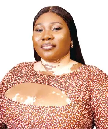 Nigerian Makeup Artist's Vitiligo Journey