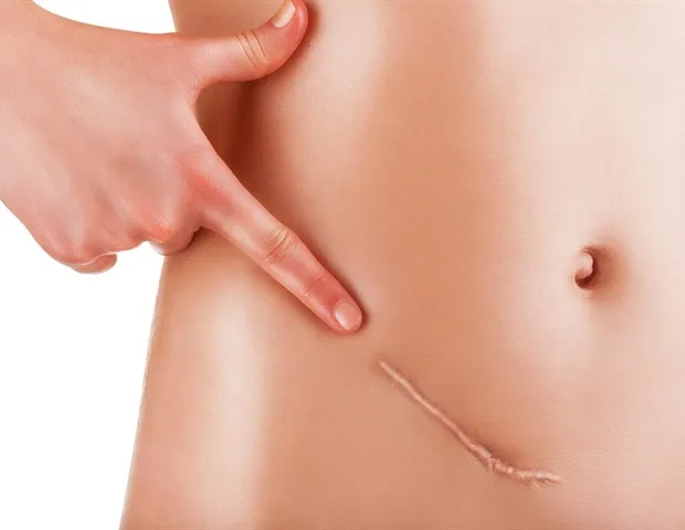 Ovarian cancer chemo resistance mechanism found
