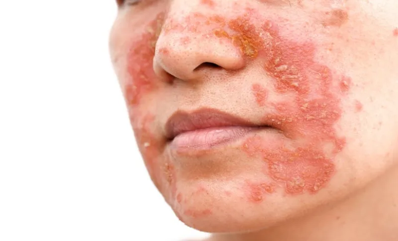 Psoriasis Biologics: Serious Infection Risk Low in UK Study