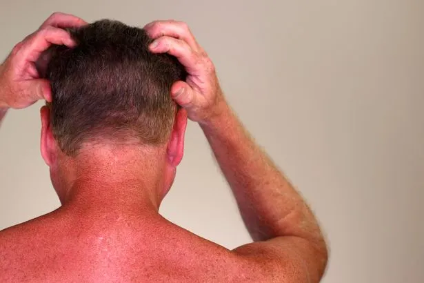 Négliger la crème solaire sur le cuir chevelu augmente le risque de cancer