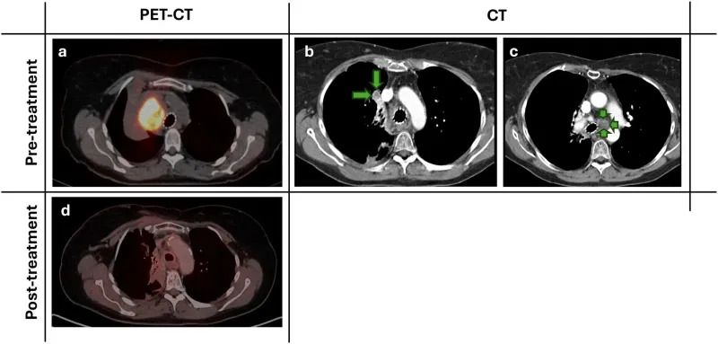 Un composé de sélénium élimine un cancer du poumon