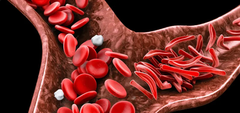 Sickle Cell Burden in Nigeria: Experts Urge Action