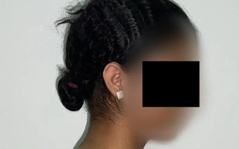 Teen's 27% Weight Removed in Gigantomastia Surgery