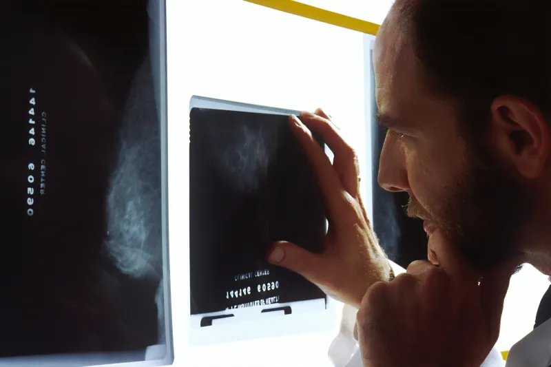 Tranexamic Acid May Reduce Liver Failure Risk